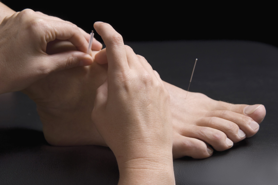 Acupuncture to foot Restorative Health